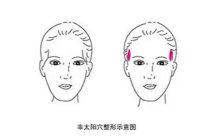 太陽穴自體脂肪填充多少錢？這4點99%的人都不知道~